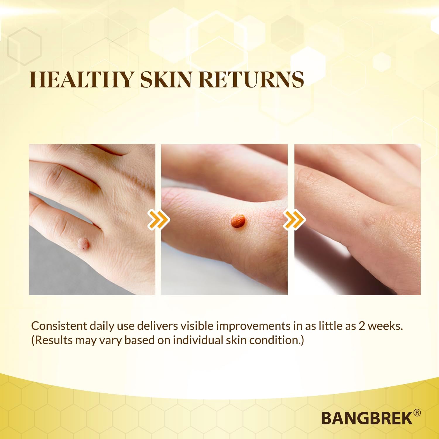 Bee Venom Wart Remover: Fast Acting Wart Remover Freeze Off for Plantar Common Flat Wart Corn Callus Removers for Toes Feet - Maximum Strength Salicylic Acid Wart Corn Callus Removers (1 FL OZ))